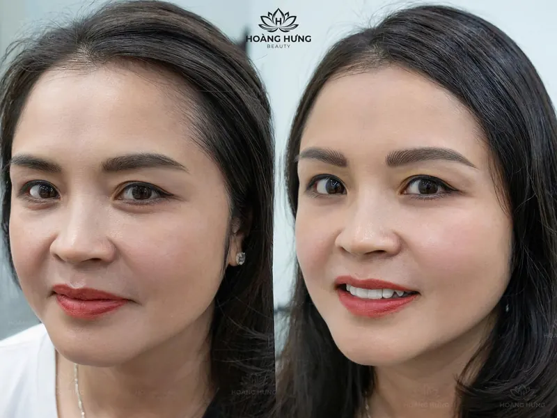 Trước và sau xoá sửa chân mày cũ — khách 2