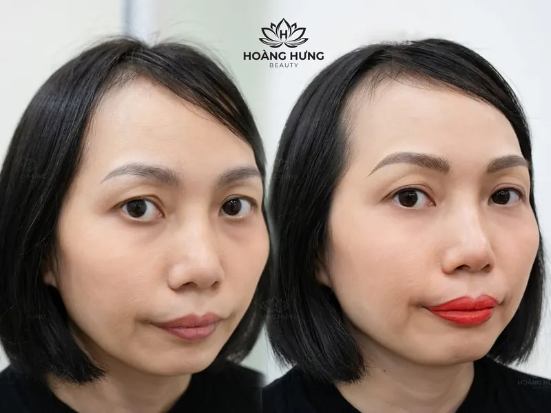 Trước và sau xoá sửa chân mày cũ — khách 1