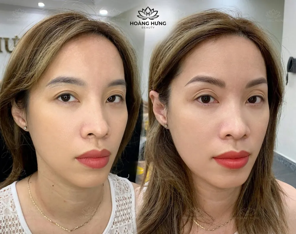 Khách hàng trước và sau khi làm đẹp tại Hoàng Hưng Beauty